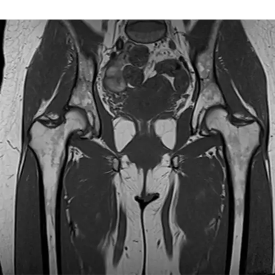 MRI Screening Of Left Hip Joint
